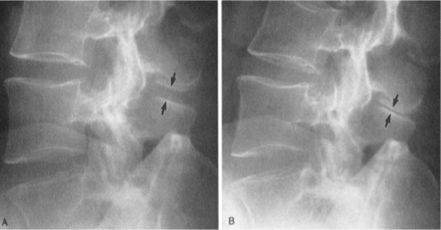 <p>ID complication of degenerative lumbar spine disease</p>