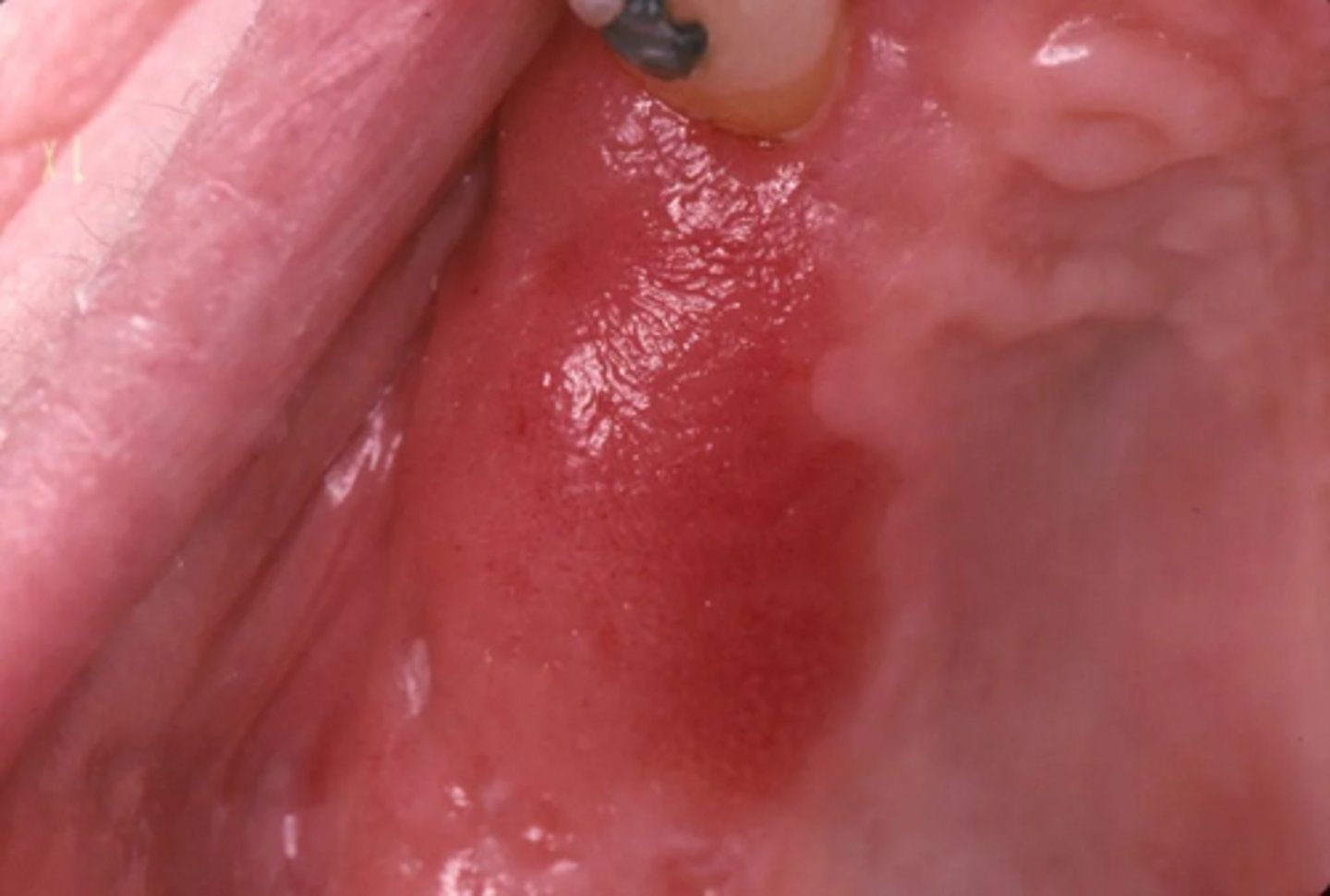 <p>A patient presents with a red, velvety lesion on the floor of the mouth that cannot be wiped off.</p><p>What is the most likely diagnosis?</p>