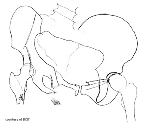 <p>Besides pelvic stabilization, what is a parallel treatment priority in combined mechanical injuries?</p>