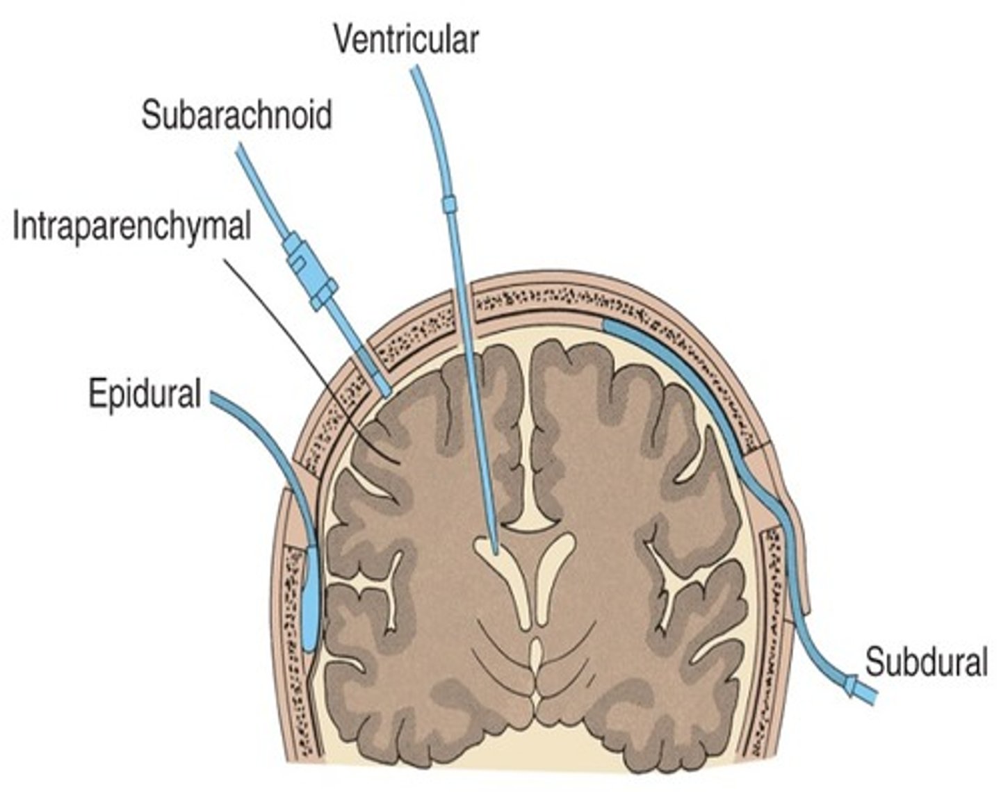 <p>C. Intraventricular catheter </p><p>Monitoring sites (Fig 16-7)</p><p>Intraventricular space</p><p>Subarachnoid space</p><p>Epidural space</p><p>Subdural space</p><p>Intraparenchymal space</p>