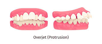 <p></p><p>Overjet</p>