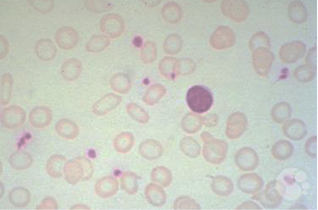 <p>what disease/condition is associated with microcytic and hypochromic cells?</p>