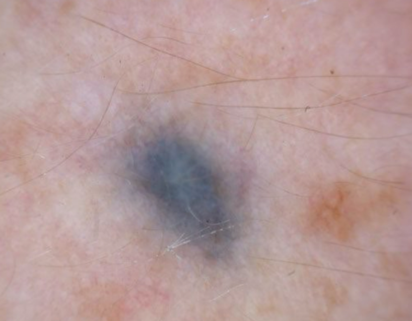 <p>what type of color change and condition is depicted</p>