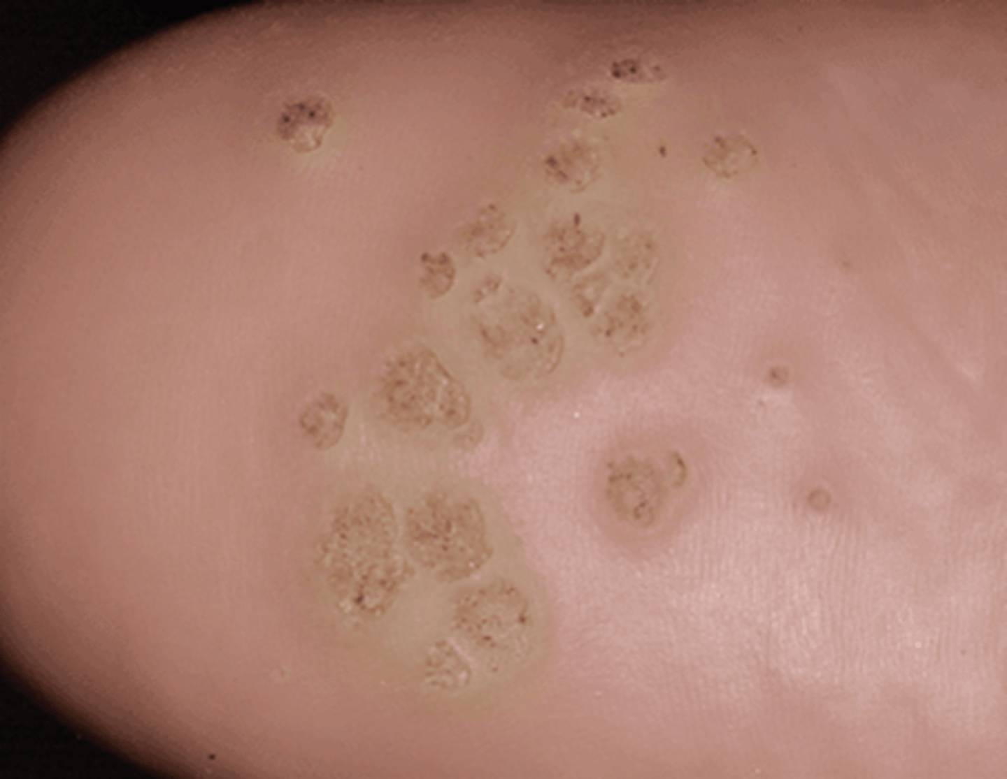 <p>warts that develop on the soles of the foot, grow inward, and can become painful</p>