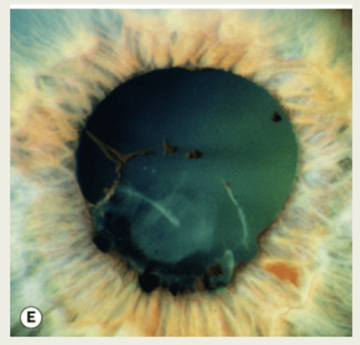 <p>exfoliation of the anterior capsule</p>
