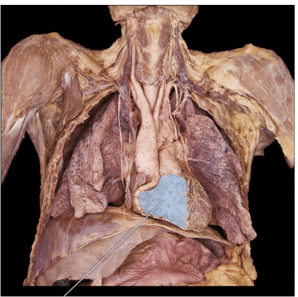 <p>right ventricle</p>