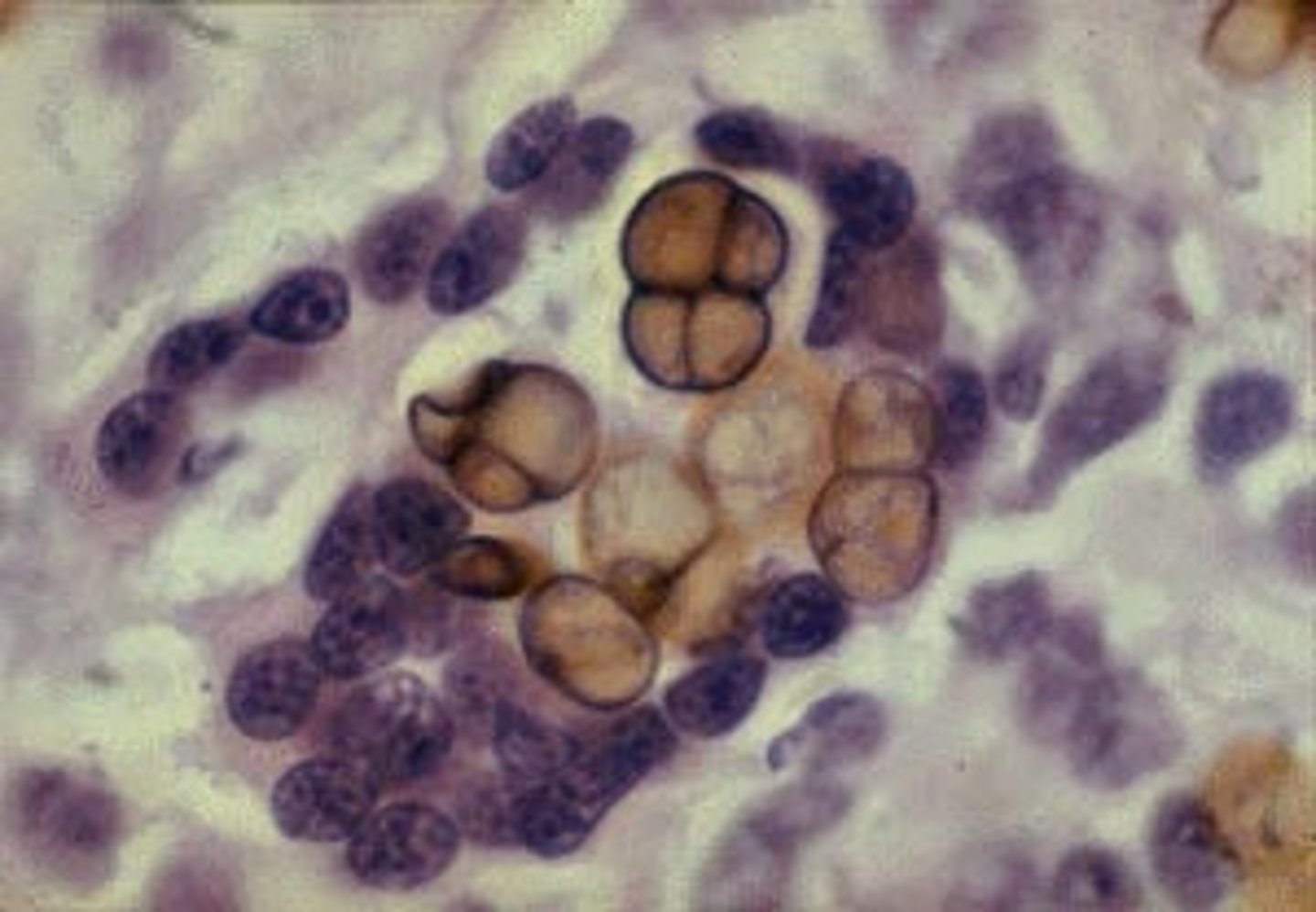 <p>Phialophora verrucosum</p>