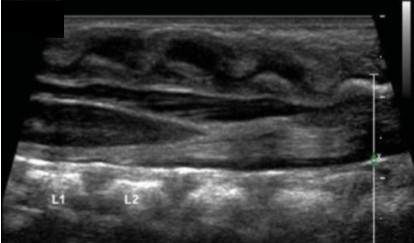 <p>Looking at this image of the filum terminale, would this be normal or abnormal?</p>