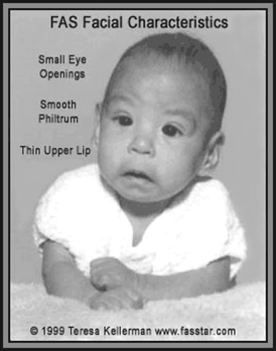 <p>-smooth ridge (philtrum) between nose and upper lip, thin upper lip, small eyes</p>