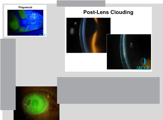 <ul><li><p>Settling time: allow 20–30 minutes for the lens to sink in</p><ul><li><p>Initial drop: 50–80 microns</p></li><li><p>Further drop after 6–8 hours wear: 50–100 microns</p></li></ul></li><li><p>Check tear film</p></li><li><p>Educate pt that tear debris is normal in nearly 30% of scleral wearers</p><ul><li><p>Reinsertion throughout the day may be needed to remove debris</p></li></ul></li></ul><p></p>