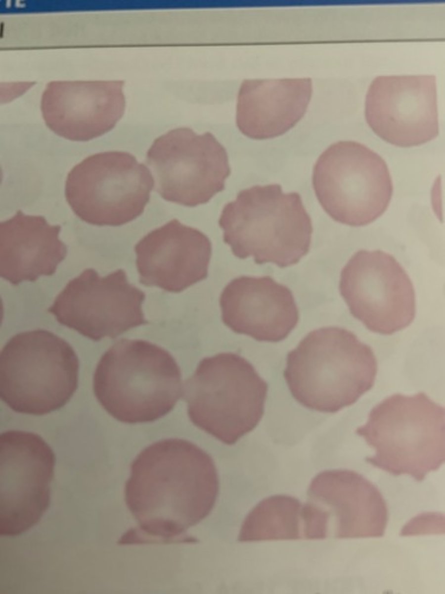 <p>aka burr cells. grooves in perimeter, osmotic imbalance</p><p>- usually drying artifact</p><p>- kidney and liver disorders</p><p>-- HUS (Shiga toxin from E. coli)</p><p>- dehydration</p><p>- HUS (Shiga toxin from E. coli)</p><p>- severe burns, gastric ulcers</p>
