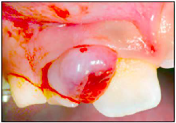 <p></p><p><span style="color: blue;"><strong><em><u>REACTIVE PROCESSES: EPULIDES</u></em></strong></span></p><p>Peripheral (soft tissue) or Central (osseous) Giant Cell Granuloma</p><ul><li><p>Clinical Signs</p></li><li><p>Etiology</p></li><li><p>Treatment</p></li></ul><p></p>