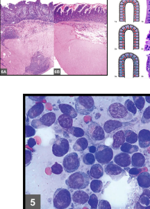 <ul><li><p><span style="color: red"><strong>MOA:</strong></span><strong> <u>Most common GI tract tumor in cats</u></strong></p><ul><li><p><u>Sm intestine</u> &gt; Lg intestine</p></li></ul></li><li><p><span style="color: red"><strong>PE:</strong></span> Poor body condition, abdominal discomfort, <u>thickened intestinal loops, palpable abdominal mass</u>,<u> icterus,</u> dyspnea/tachypnea</p></li><li><p><span style="color: red"><strong>ID:</strong> </span><strong>FNA, biopsy</strong></p></li><li><p><span style="color: red"><strong>TX:</strong></span><strong> </strong>Chemo, Vit B12, Anti-emetics, anti-diarrheals, appetite stimulants</p><ul><li><p><span style="color: red"><strong><u>Sm cell chemo:</u></strong></span><strong><u> Chlorambucil &amp; pred</u></strong></p><ul><li><p><strong><u>good prognosis</u></strong><u>, 3m resolution</u></p></li></ul></li><li><p><span style="color: red"><strong><u>Lg cell chemo: </u></strong></span><strong><u>CHOP,</u></strong> Doxorubicin &amp; pred, Lomustine, Pred</p><ul><li><p><strong><u>guarded to poor prognosis</u></strong></p></li></ul></li></ul></li></ul><p></p>