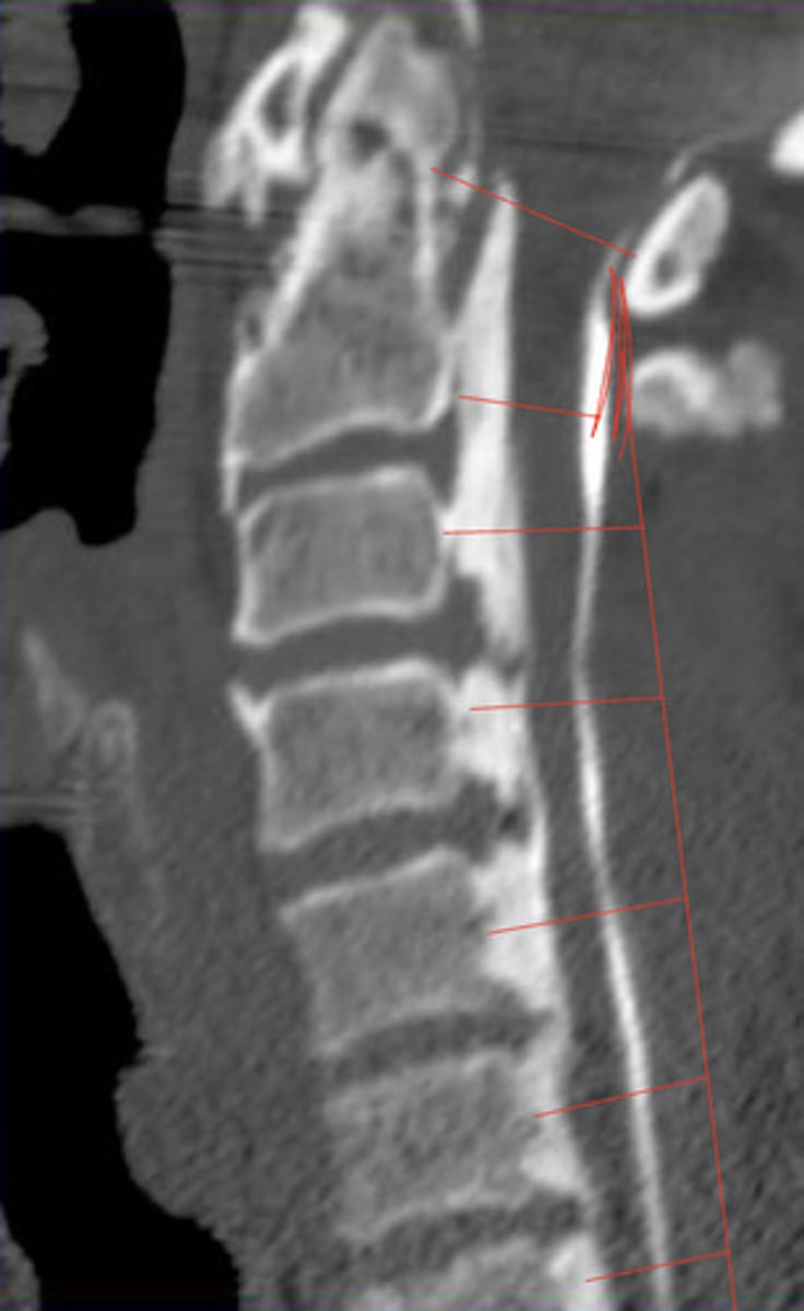 <p>What is the lateral sagittal canal size for each cervical</p>