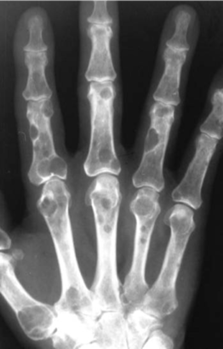 <p>ID imaging finding of multiple myeloma</p>