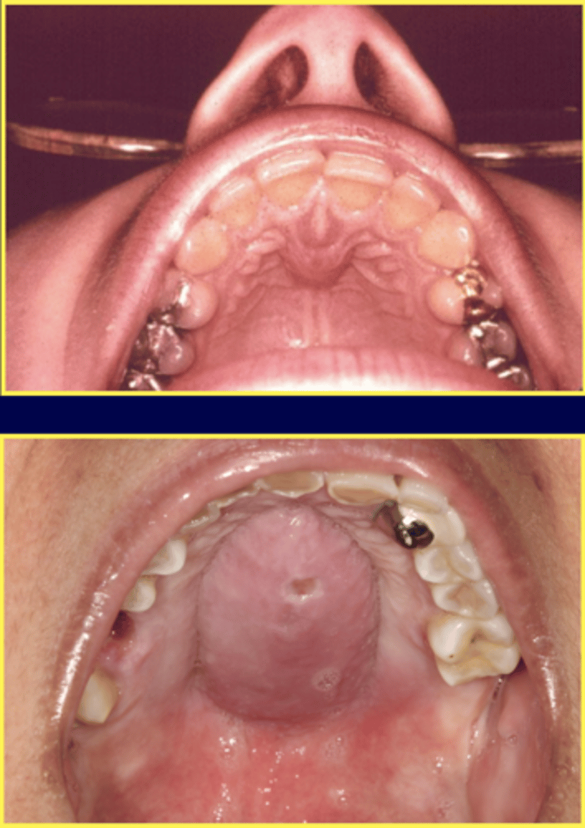 <p>What is the treatment of Nasopalatine duct cyst? </p>