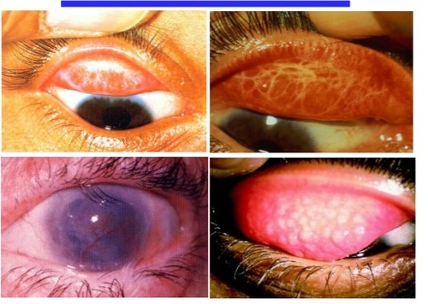 <p>swollen conjunctiva that typically leads to blindness if left untreated</p>