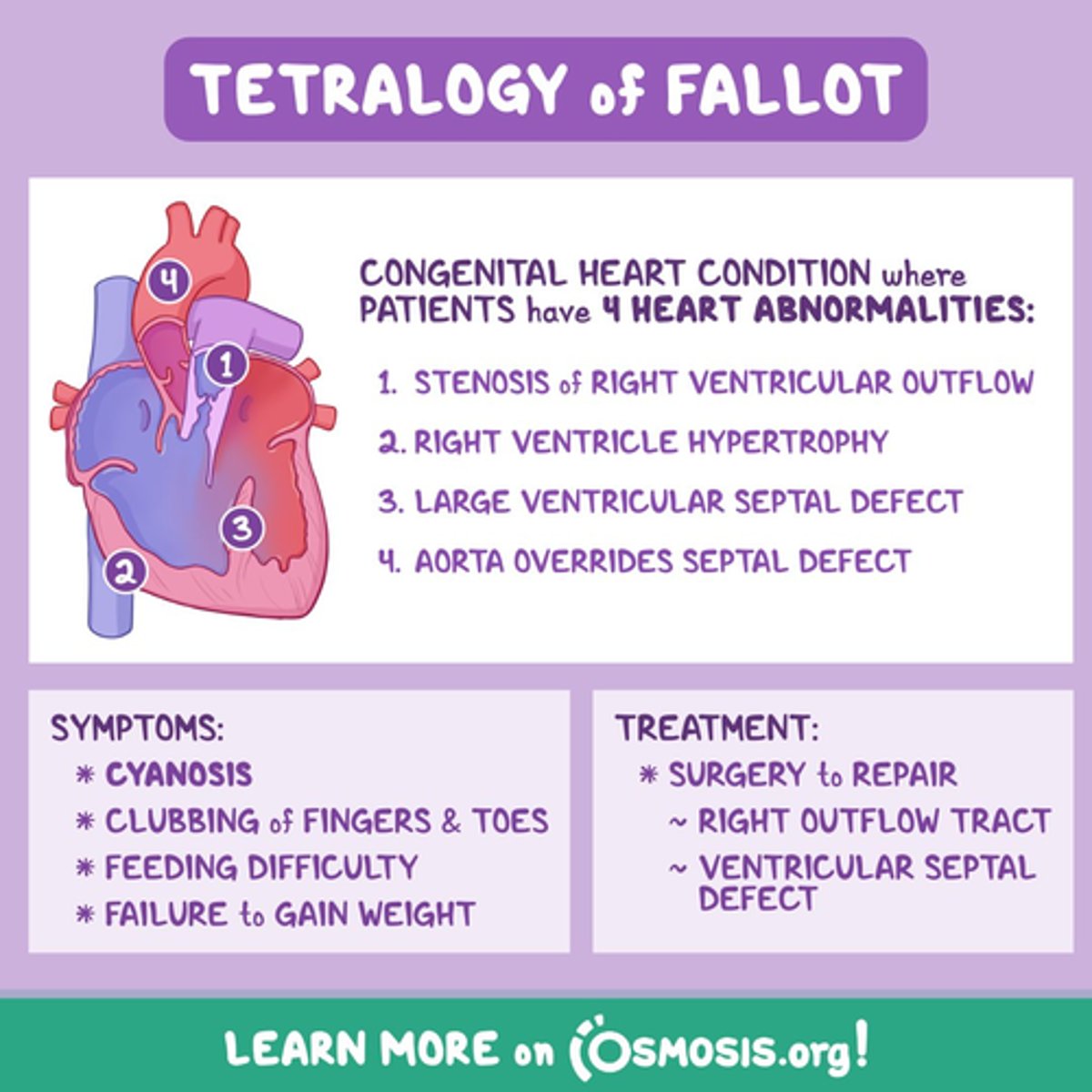 <p>Tetralogy of Fallot - boot shaped heart </p><p>PS</p><p>RVH</p><p>Overide aorta </p><p>VSD</p>