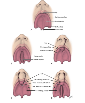 <ul><li><p>cleft palate </p></li></ul><p></p>