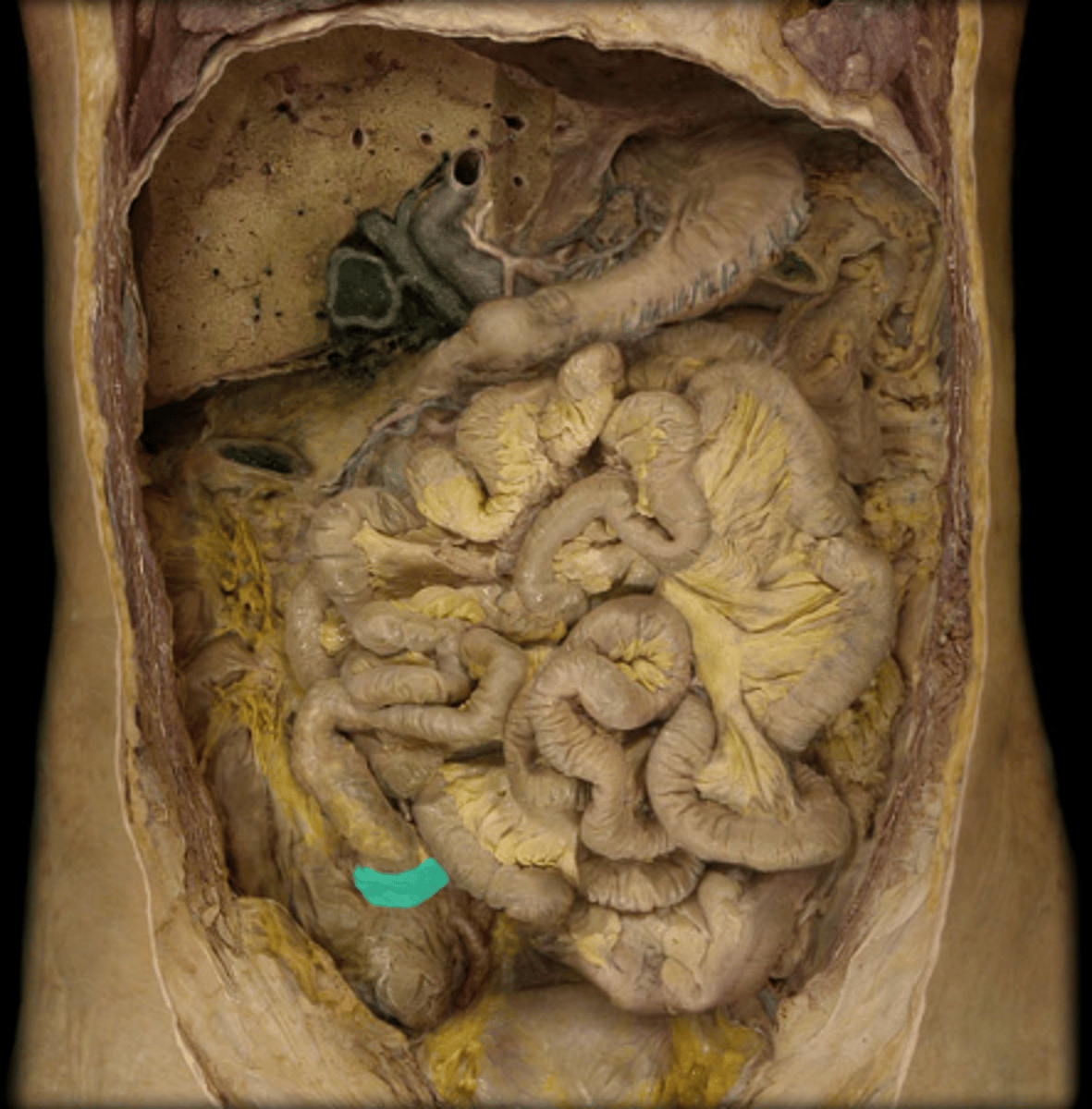 <p>The valve that controls the flow between the ileum and the cecum.</p>