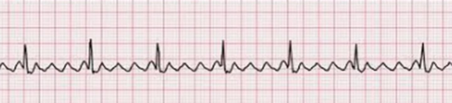 <p>regular rhythm</p><p>treat with</p><p>-cardioversion</p><p>-antiarrhythmic</p><p>-anticoags</p>