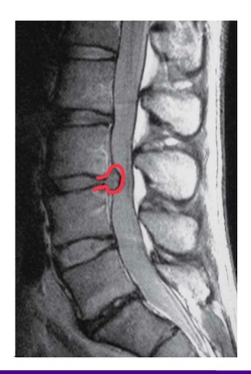 <p>what injury is in this image?</p>