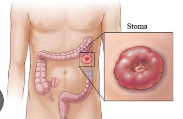 <p><strong>allows stool to bypass diseased/damaged colon through connection of colon mucosa to abdominal skin wall for stool drainage into collection pouch </strong><br>-section of colon may be removed for infection, ulcerative colitis, trauma, ischemia, cancer resection </p>