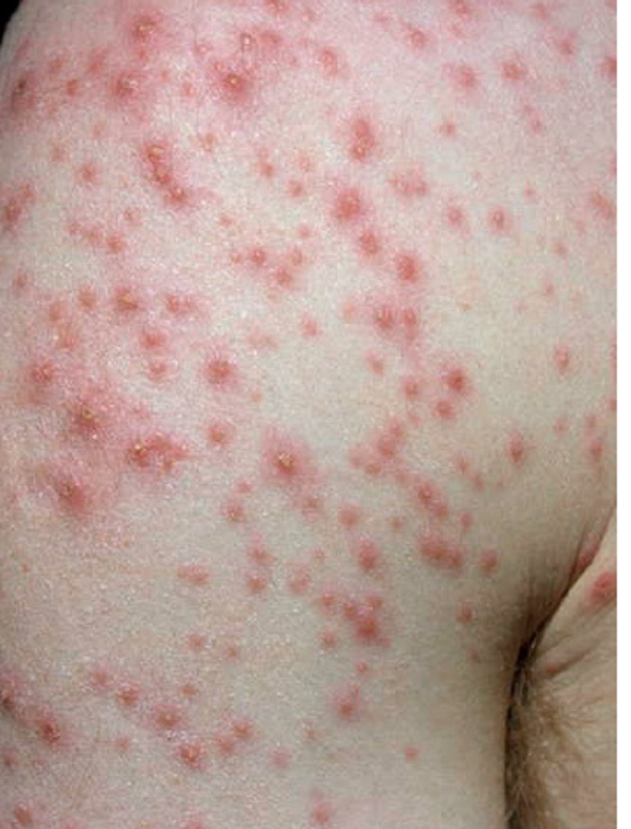 <p>HIGHLY contagious latent virus, causes shingles</p><p>- prevented with vaccine</p><p>- very itchy</p><p>Rash starts on chest and spreads UP</p><p>Lesions in different stages (macules, papules, vesicles, crust)</p><p>Airborne and Contact precautions</p>