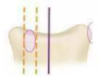 <p>pedicle disappears</p>