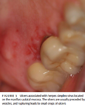 <p><span style="color: blue;"><strong><em><u>SPECIFIC INFECTIONS</u></em></strong></span></p><p>Herpetic Gingivostomatitis</p><ul><li><p>Clinical Signs</p></li><li><p>Location</p></li><li><p>Etiology</p></li><li><p>Treatment</p></li></ul><p></p>