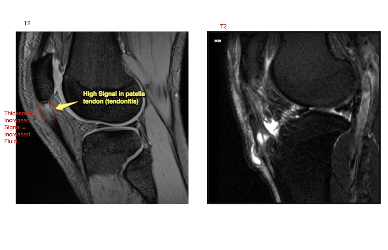 <p>Patella Tendon Pathology: MOI</p><ul><li><p>4 main MOI</p></li></ul><p></p><p></p>