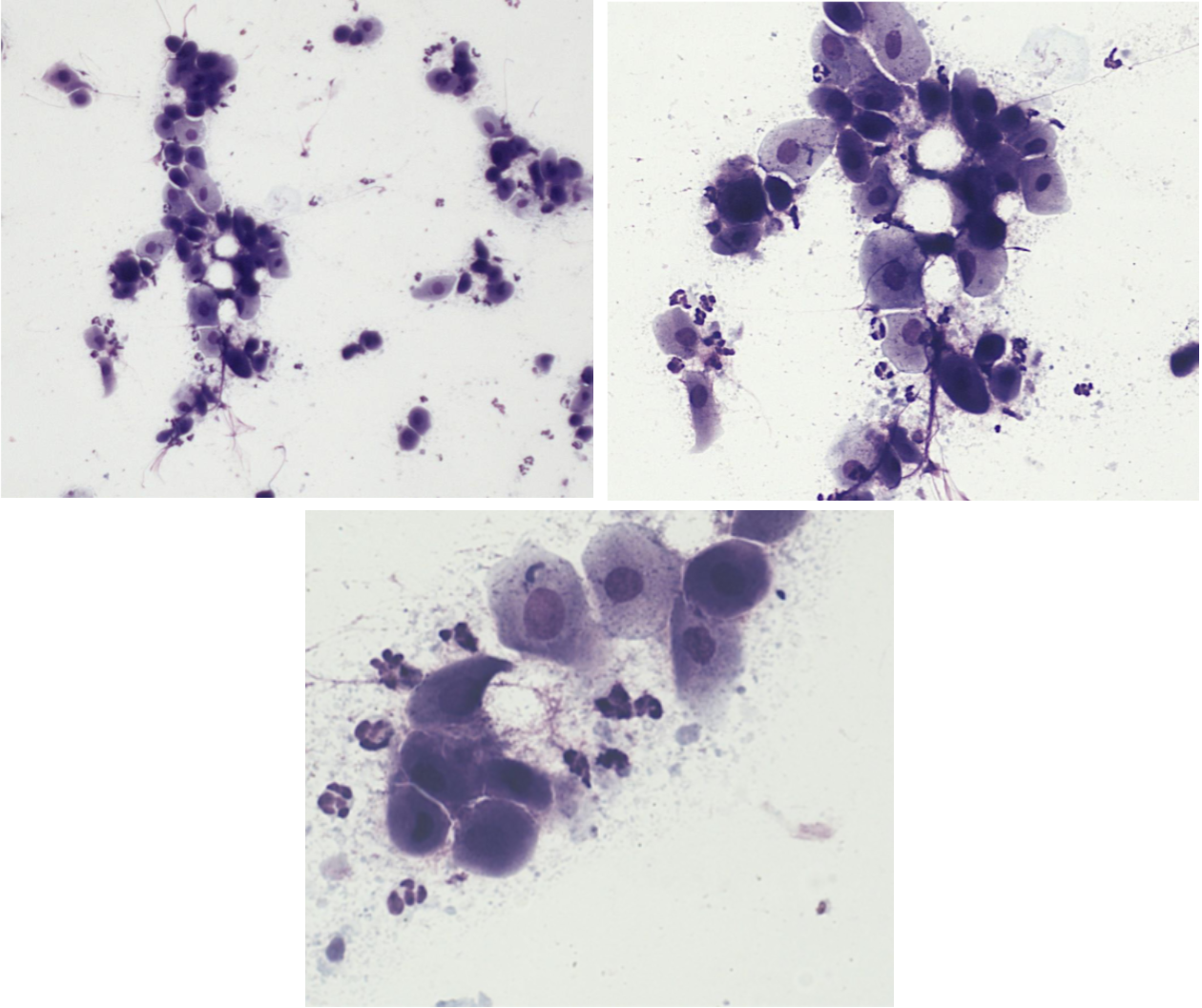 <p>Utstryk 3<br>Parabasalceller: <br>Intermediärceller: <br>Superficialceller: <br>Erytrocyter: <br>Neutrofiler:</p><p>Stadium:</p>