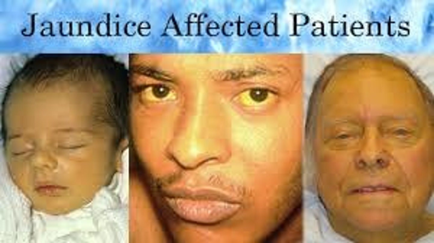 <p>Jaundice</p>