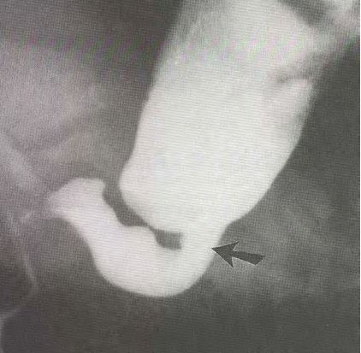 <p>Initial: abdominal x-ray followed by contrast enema &amp; anorectal manometry (evaluates whether or not they can create pressure)</p><p>Definitive: rectal biopsy</p>