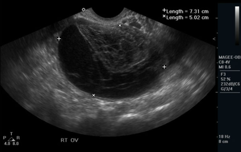 <ul><li><p>Any type of cyst may become hemorrhagic</p></li><li><p>Bleeding within the cyst</p></li><li><p>Typical with <span style="color: rgb(255, 0, 0)">follicular</span> or <span style="color: rgb(255, 0, 0)">corpus luteal cysts</span></p></li><li><p>Will vary in US appearance</p><ul><li><p>stage of bleed</p></li><li><p>internal debris</p></li><li><p>septations</p></li><li><p>free fluid</p></li></ul></li></ul><p></p>