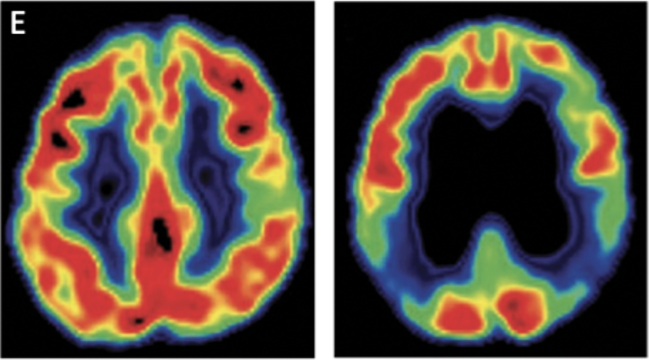 <p>gives images of brain activity using radioactive chemicals in blood stream</p>