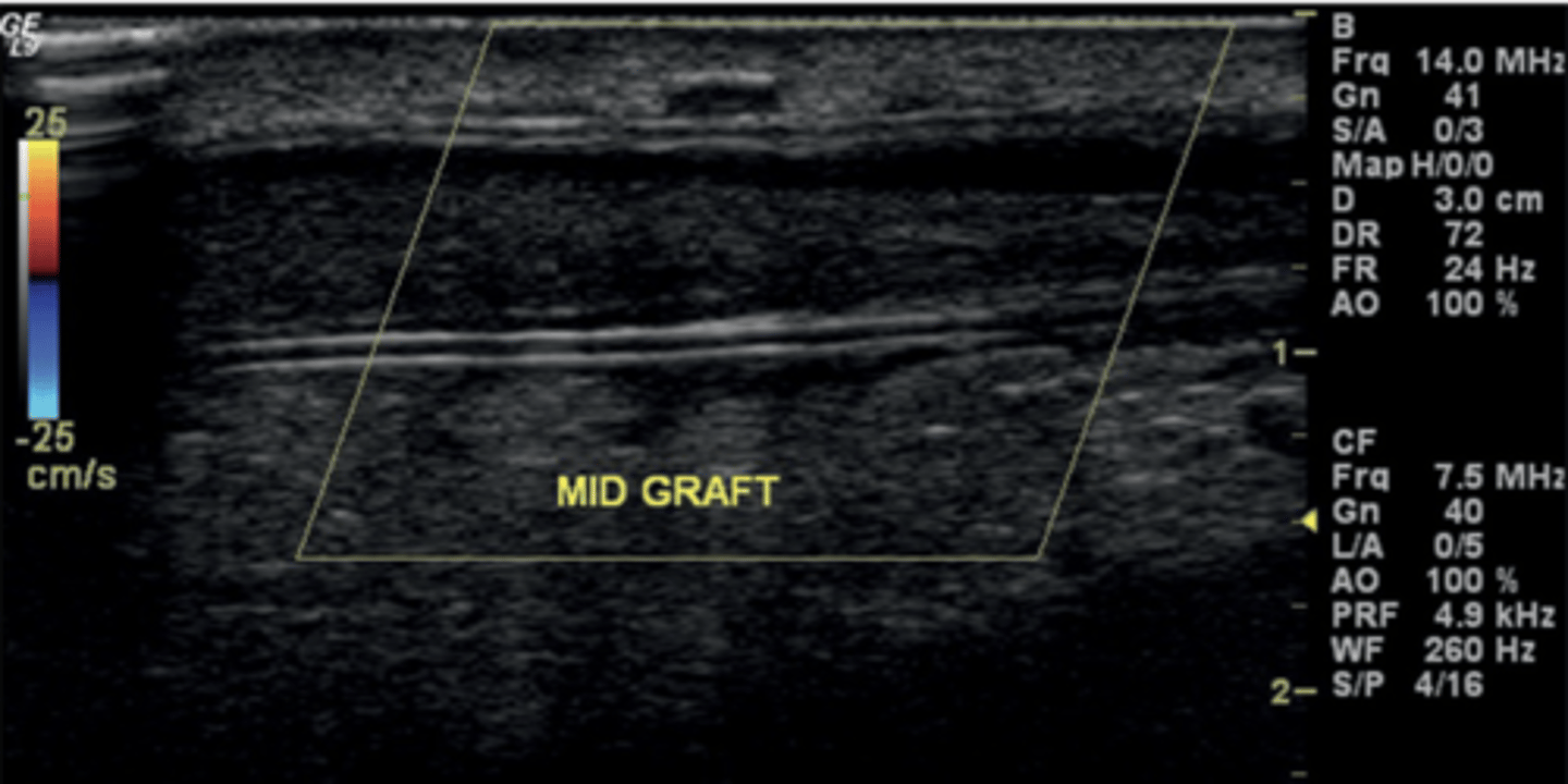 <p>Absent flow in lumen</p><p>Echogenic thrombus in lumen</p><p>Prox high-resistant flow</p>