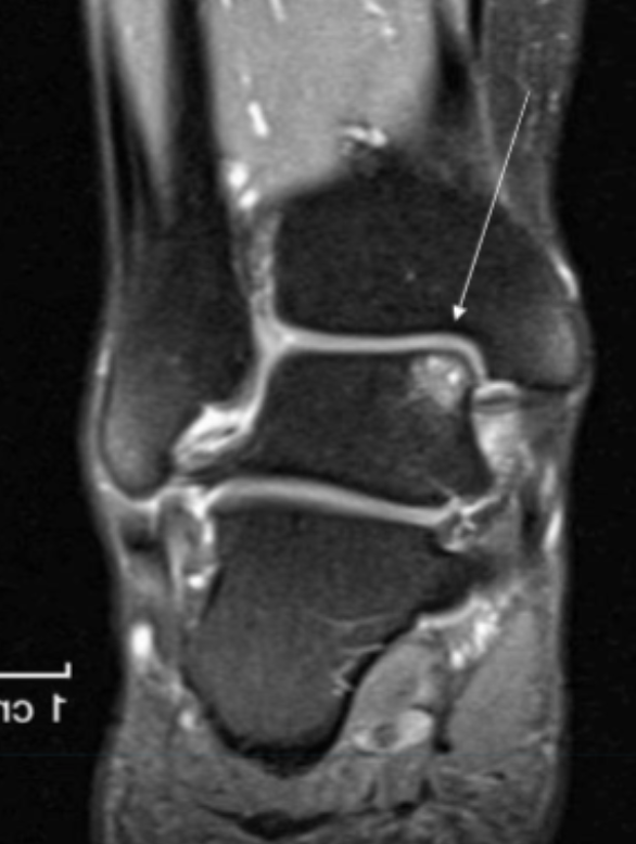 <p>Describe the pathology indicated by the arrow (Cor T2 FS). </p>