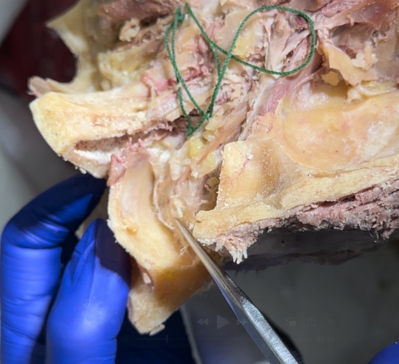 <p>Around the eye you will see</p>