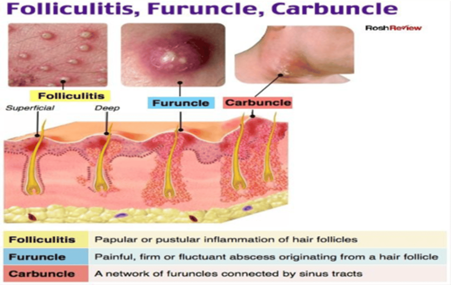 <p>Furuncle: Skin abscesses at the hair follicle and surrounding tissues</p><p>Carbuncle: ØMultiple furuncles form a carbuncle</p>