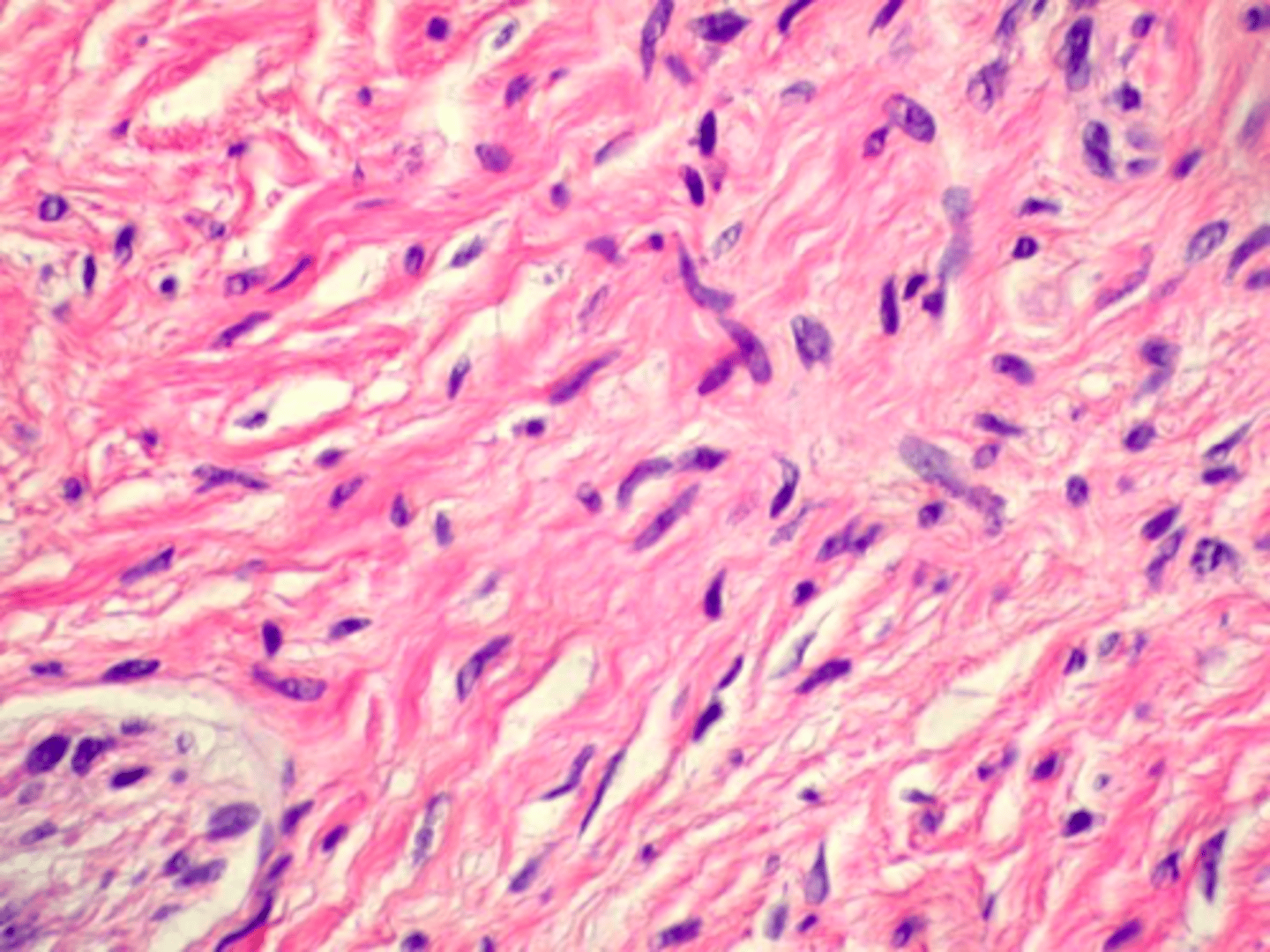 <p>interlacing bundles of spindle-cells with wavy nuclei is associated with what pathology?</p>