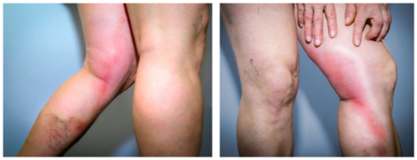 <p>- veins swell, red path in tissue<br>- very painful<br>- inflammation due to vessel wall injury<br>- can be caused by catheter placement or IV fluid administration</p>