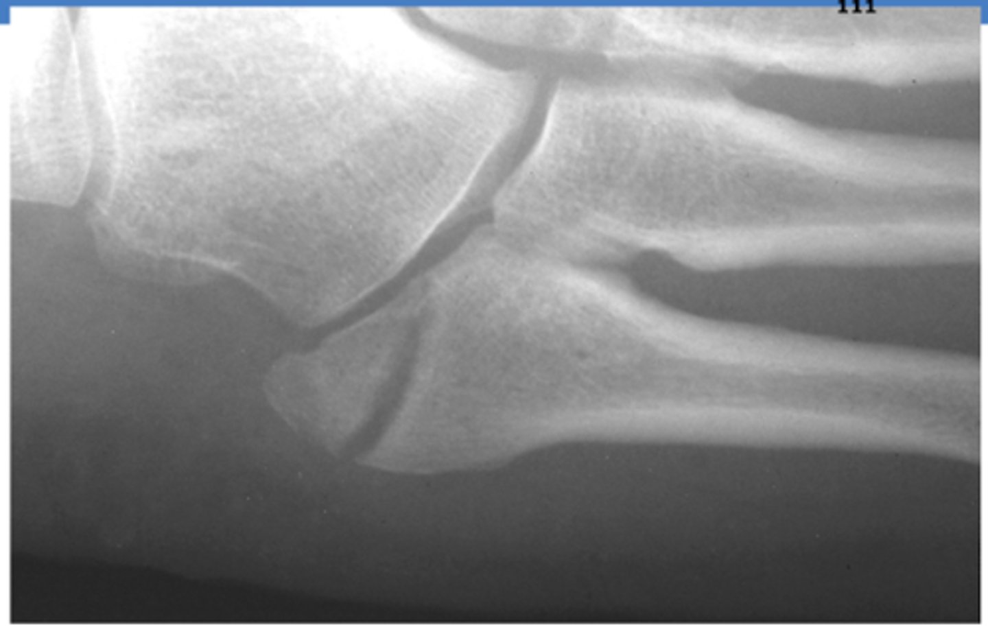 <p>Jone's fracture</p>