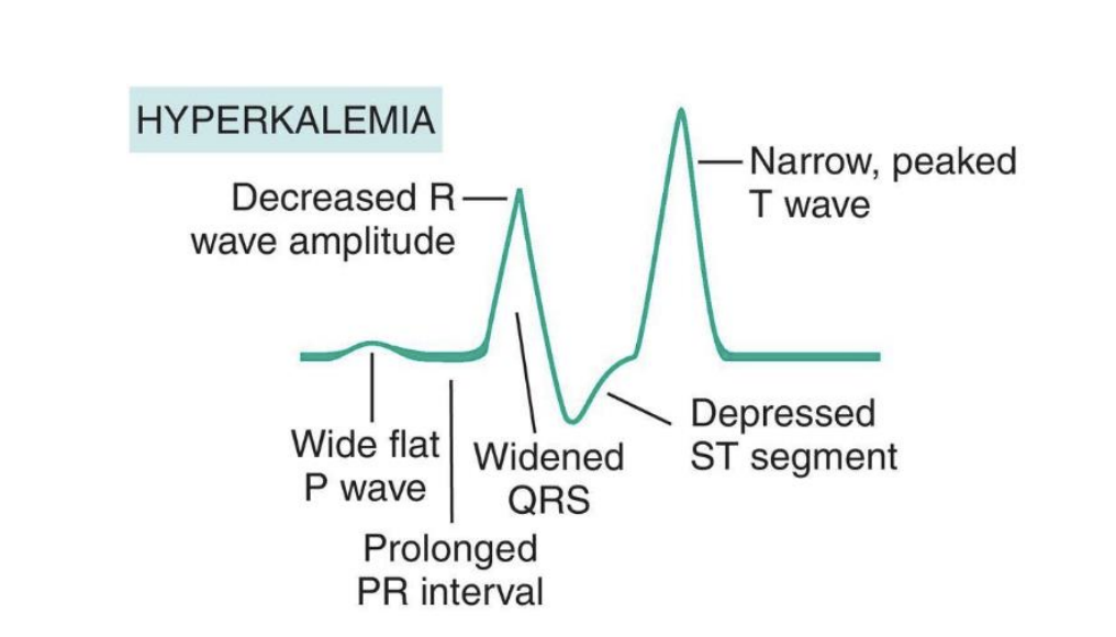 <p>muscle weakness, spasticity</p><p>EKG (wide QRS w/ Tall peaked T waves)</p>