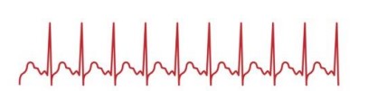 <p>What is <strong>tachycardia</strong> ?</p>