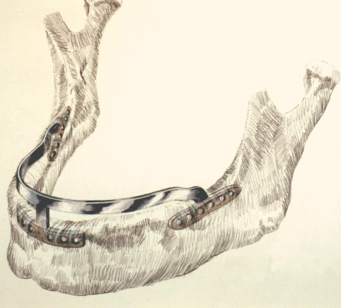 <p>In which cases are ramus frame implants used?</p>