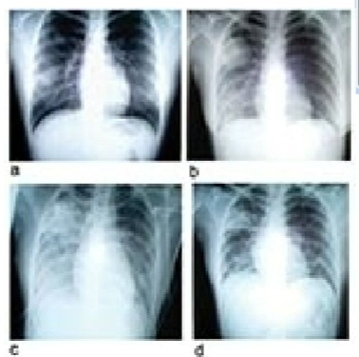 <p>Chest radiographs of index patient with severe acute respiratory syndrome (SARS). a, day 5 of symptoms; b, day 10; c, day 13; d, day 15.</p>