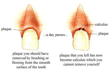 <p>Plaque vs Calculus</p>