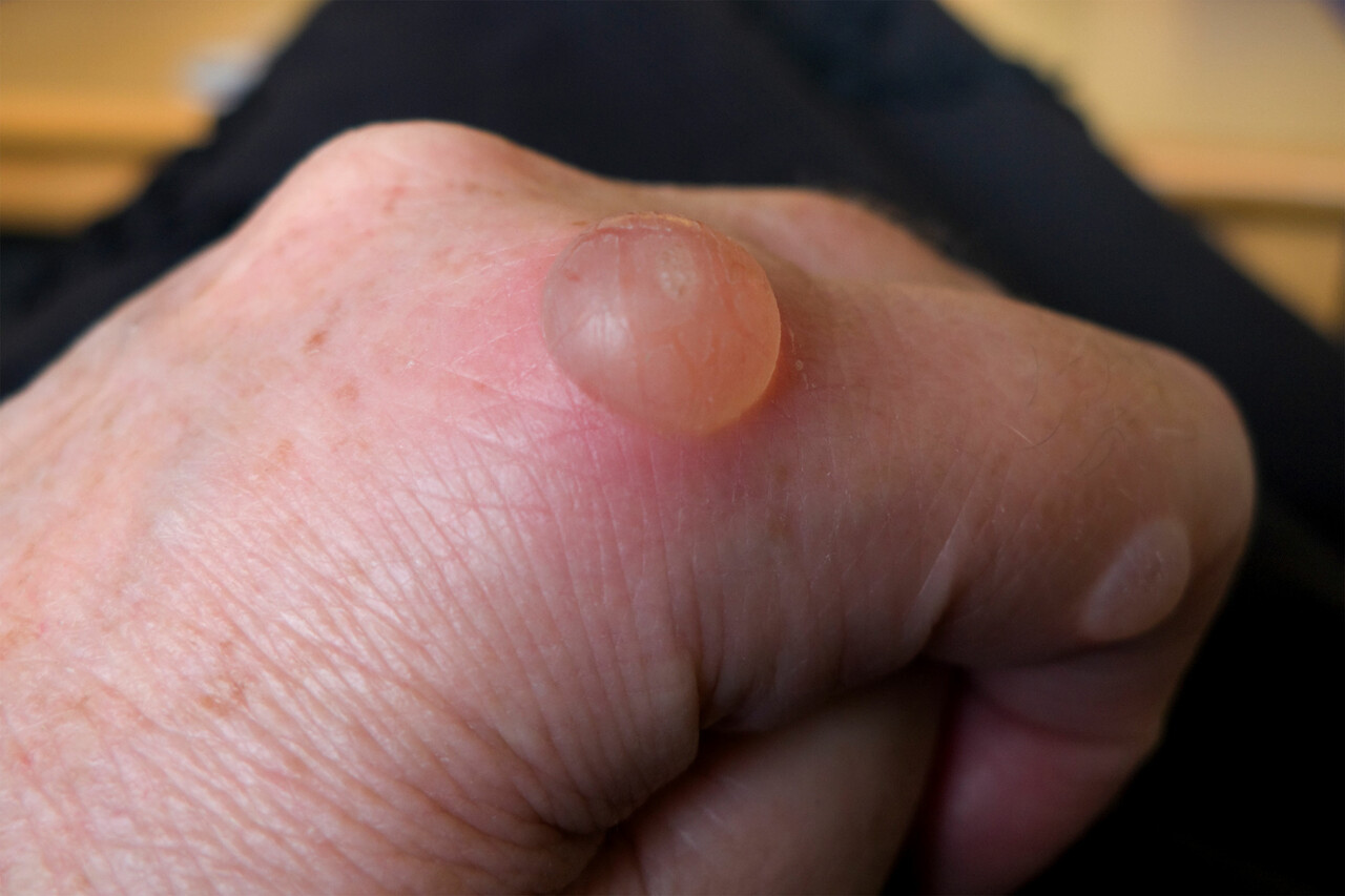 <p>A small pocket of fluid on the skin caused by friction, heat, or irritation</p>