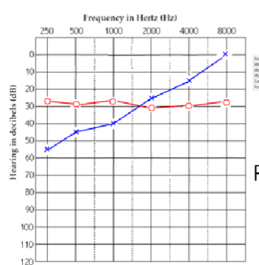 <p>What patient is this? what kind of hearing loss is this?</p>